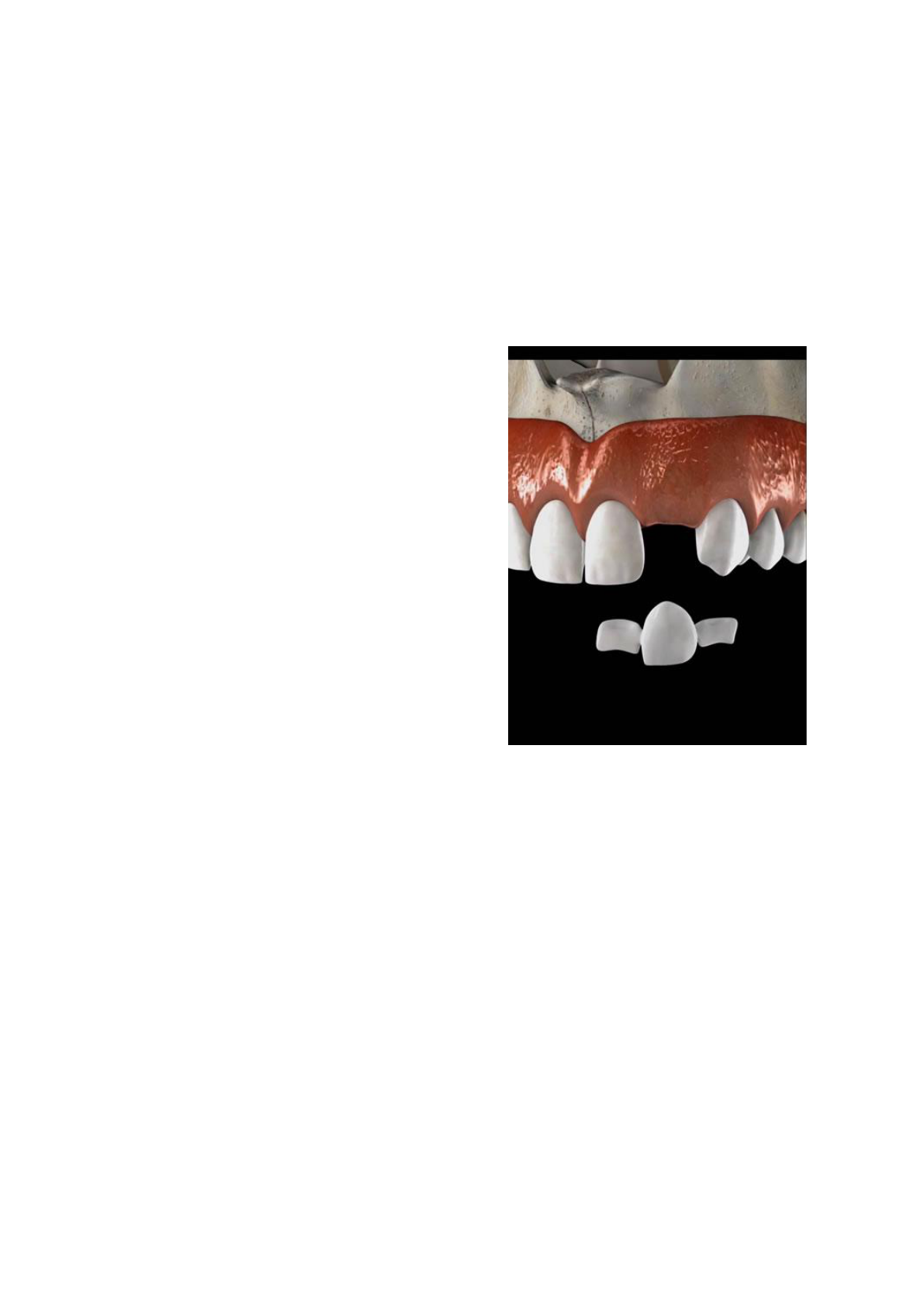 Próteses dentárias de um único molar projetadas por IA