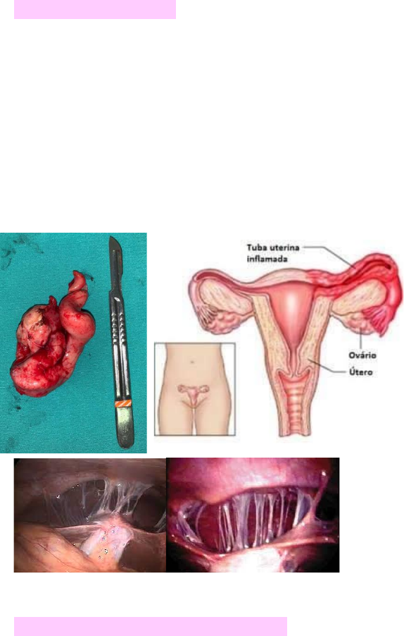 Dr. Carlos Roberto - Ginecologia - A DIPA (Doença Inflamatória Pélvica  Aguda) é uma infecção dos órgãos reprodutivos femininos (útero, trompas e  ovários). ▫ A DIPA ocorre quando bactérias patogênicas proliferam na