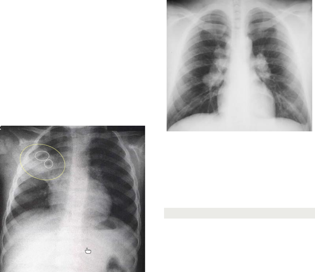 Coccidioides/Coccidioidomicose | Concise Medical Knowledge, image size:1056x911