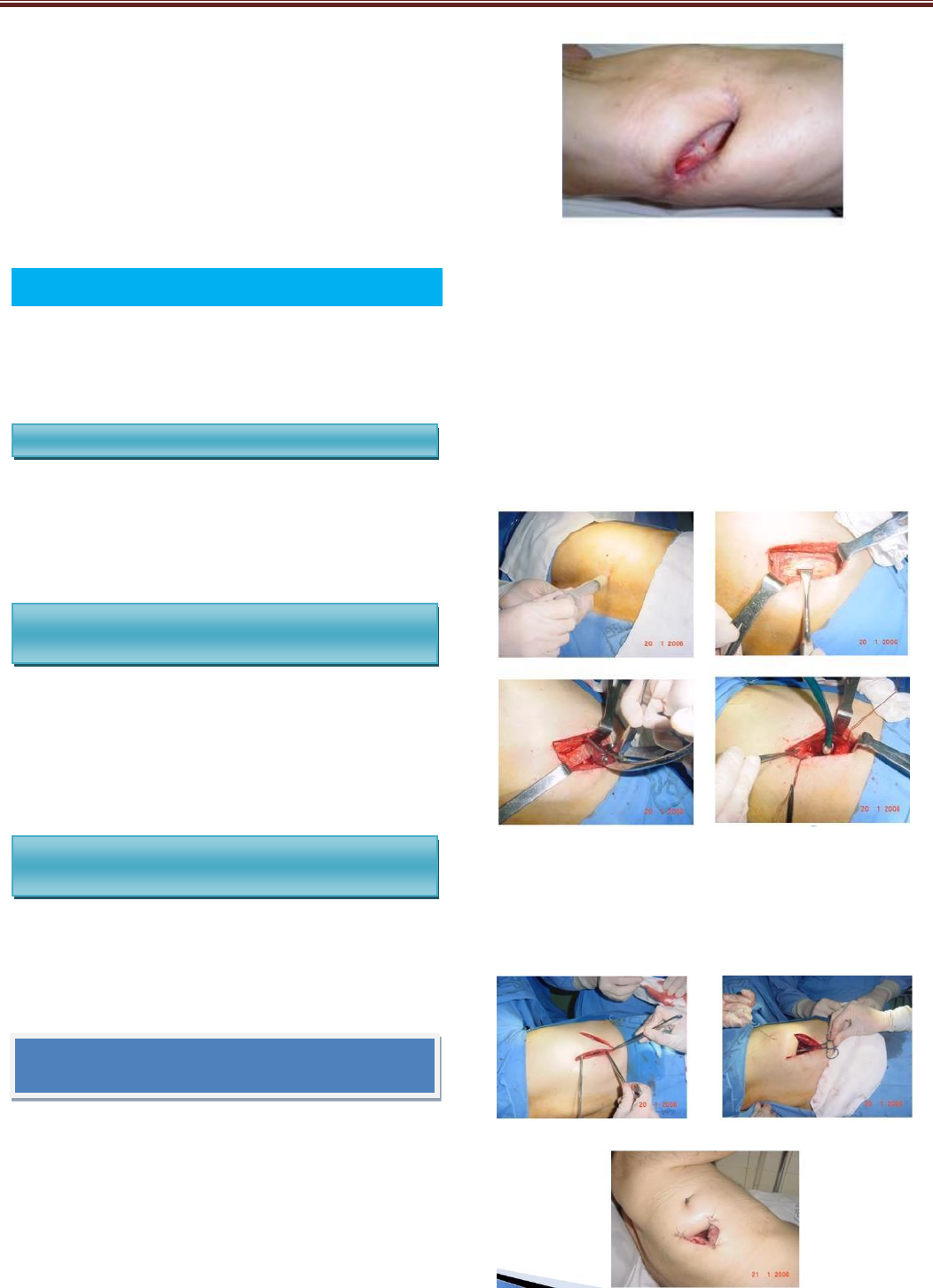 DRENAGEM - Cirurgia