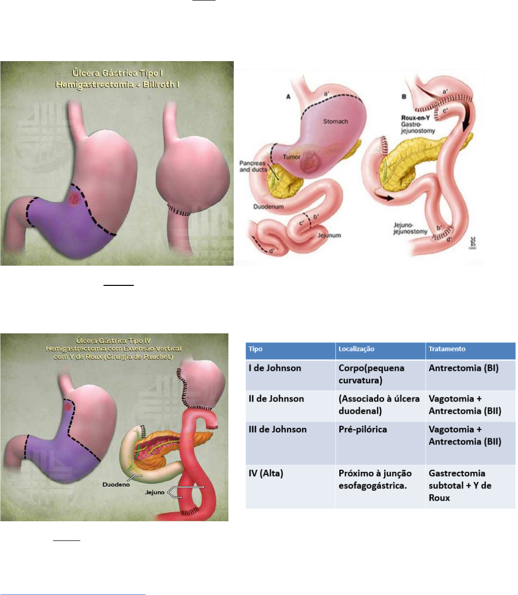 vagotomía y piloroplastia