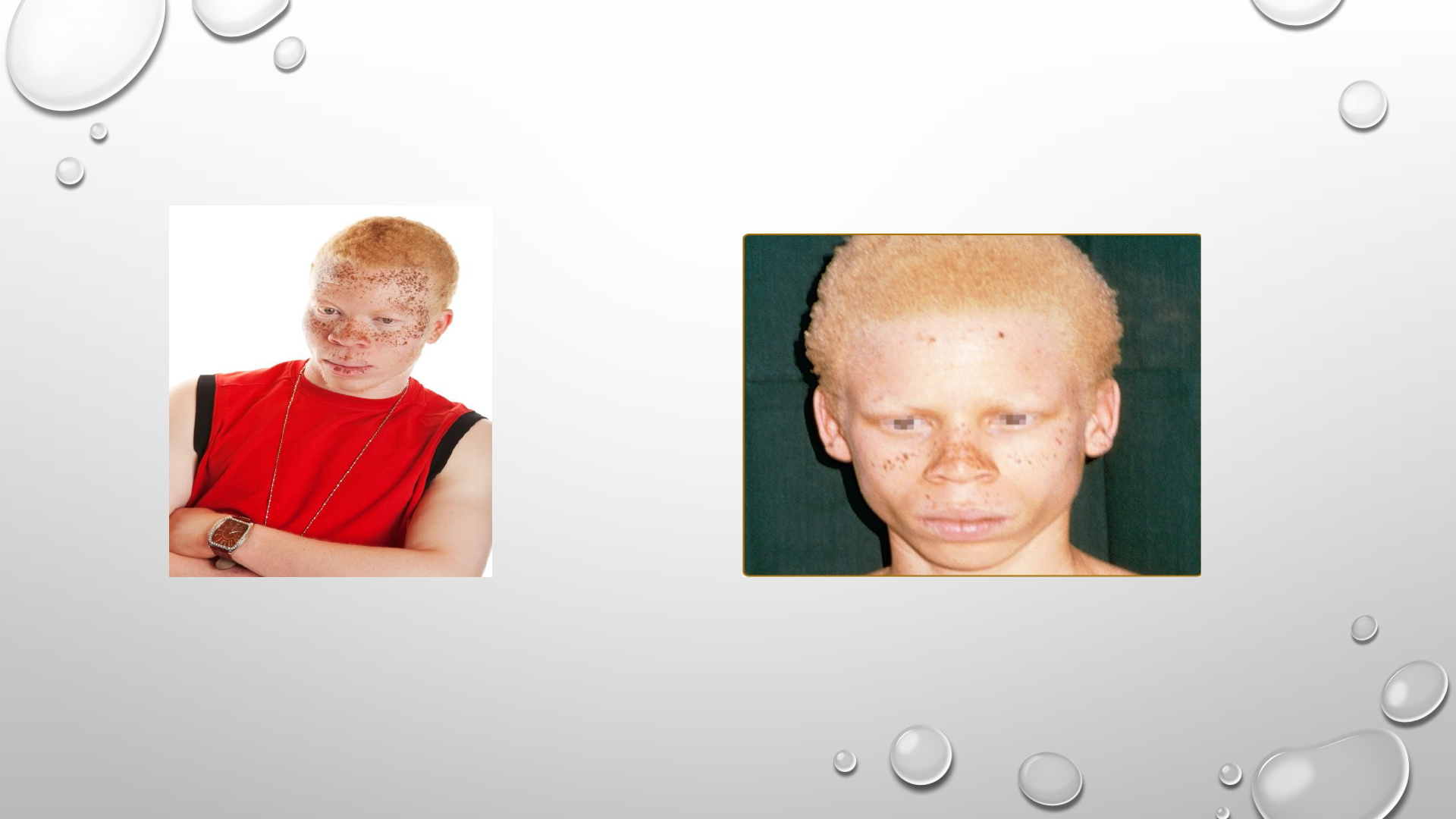 Saúde e a química da célula humana: Albinismo Ocular do Tipo 1, image size:1920x1080