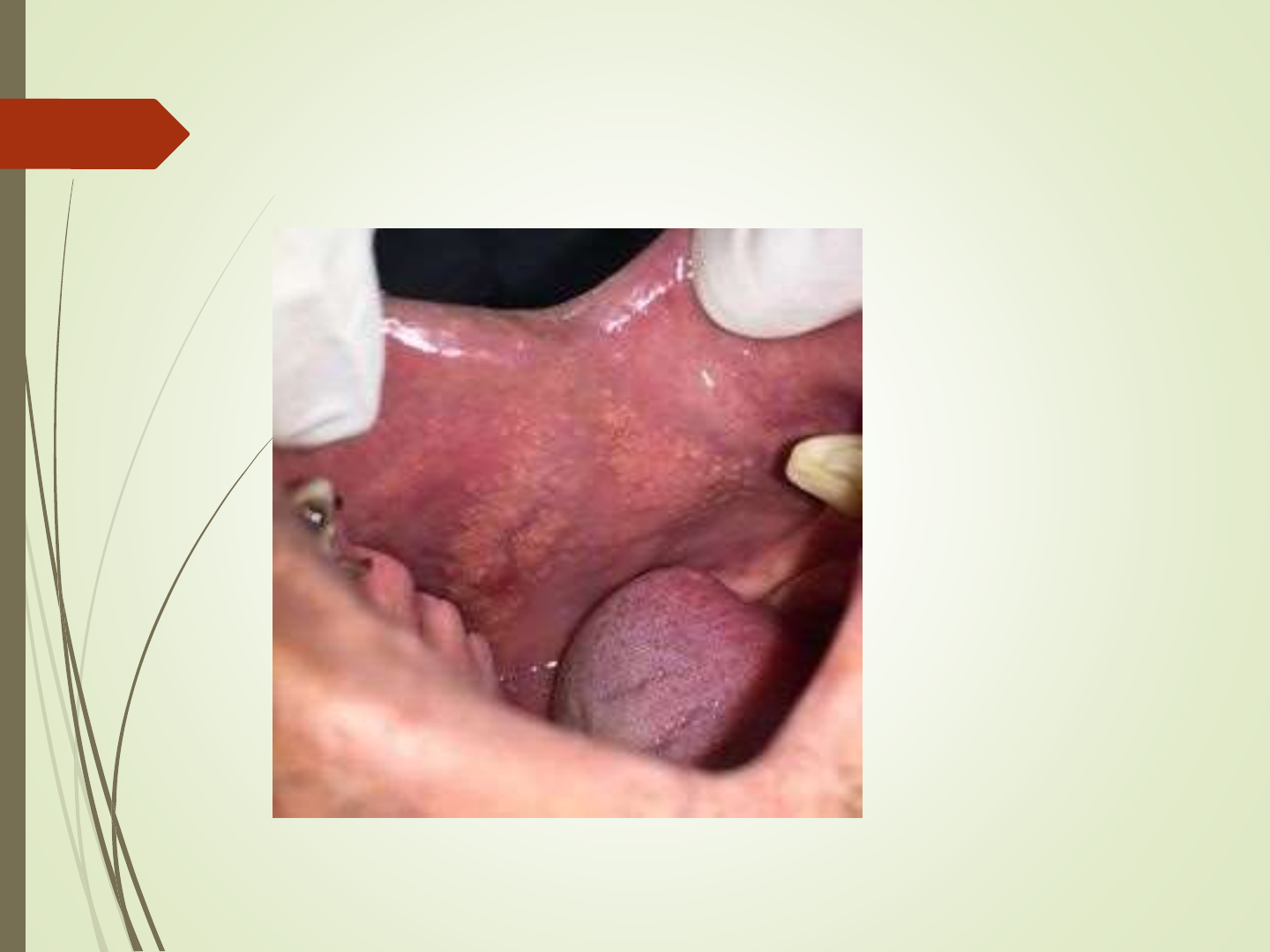 Microglossia, Macroglossia e Grânulos de Fordyce - Imaginologia