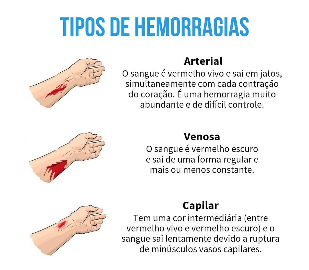 Tipos De Hemorragias Enfermagem Hot Sex Picture