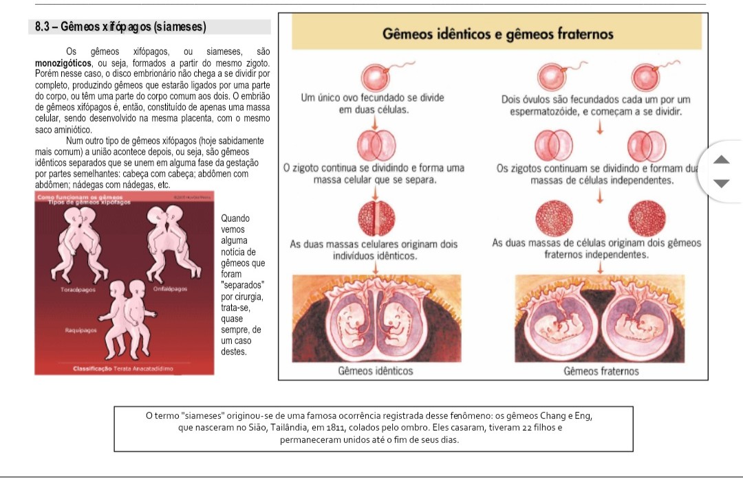 Tipos De Gemeos Siameses Gêmeos Siameses: Por Que Duas Pessoas Nascem