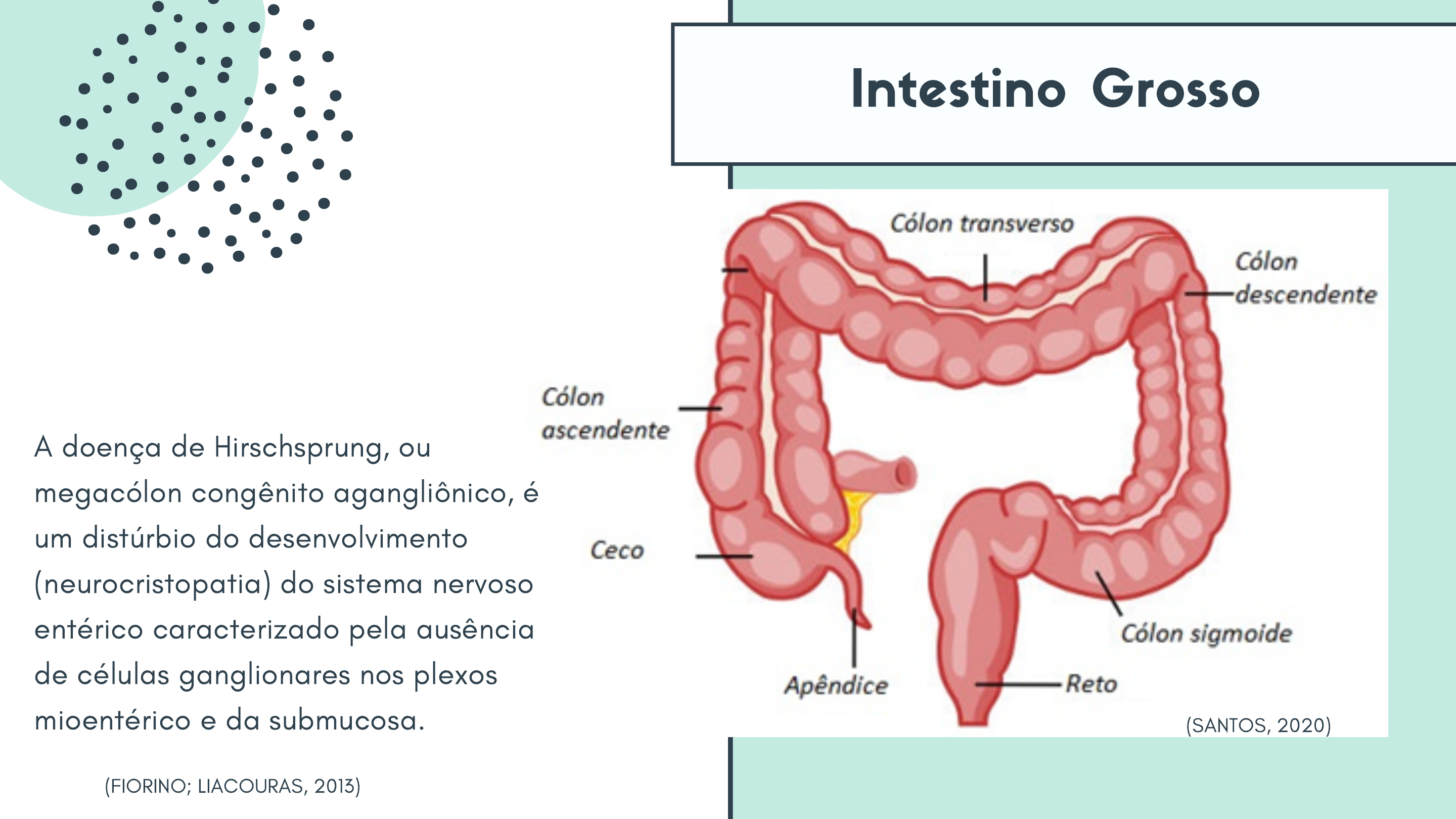 Cirurgia para Doença de Hirschsprung. Abaixamento de cólon à Duhamel. Em  pacientes com colostomia prévia, optamos pela cirurgia de Duhamel. Em  crianças sem grandes dilatações de cólon, com diagnóstico precoce e forma, image size:2880x1620