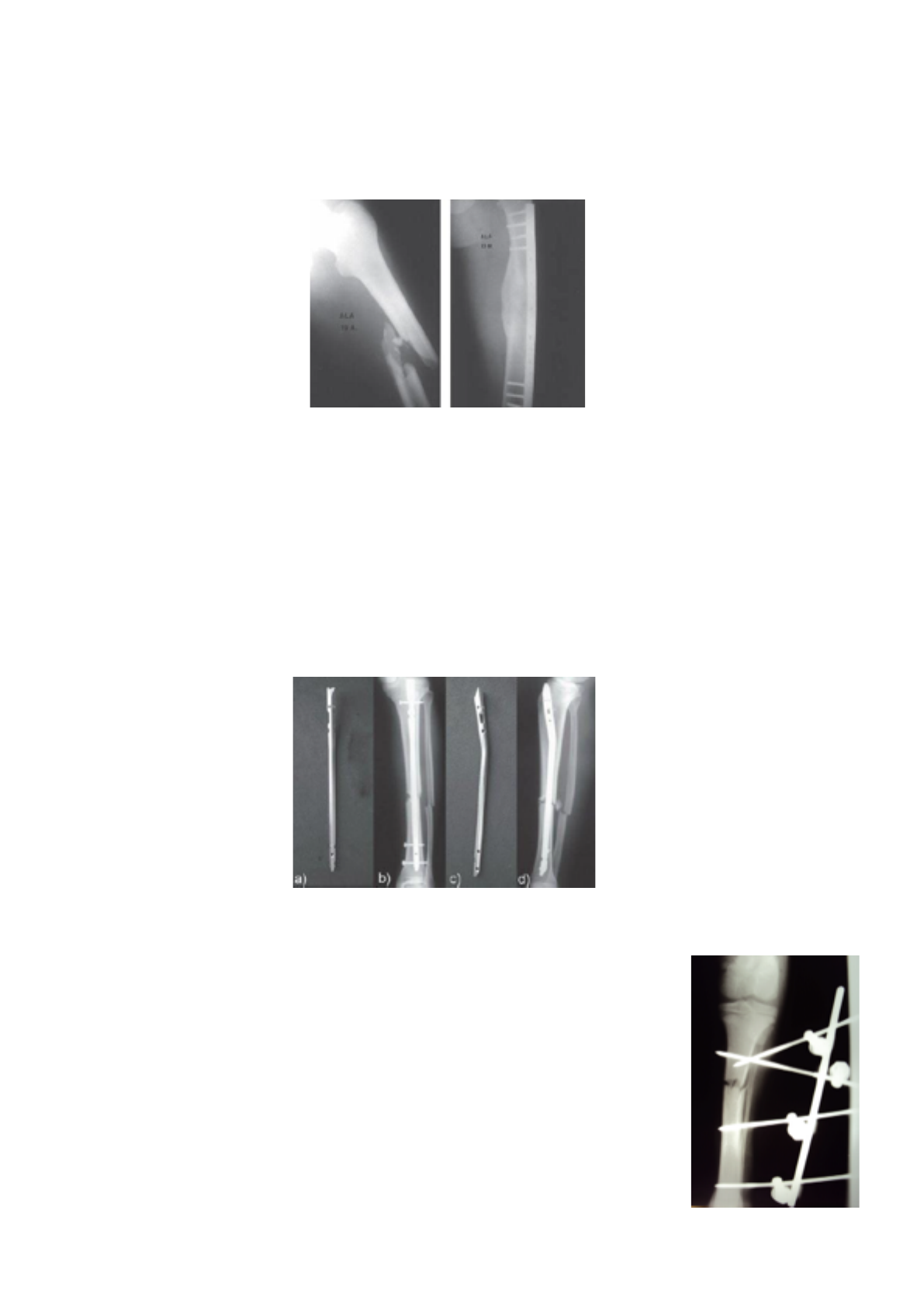 Caixa de haste intramedular para tíbia - CZMEDITECH, image size:1191x1684