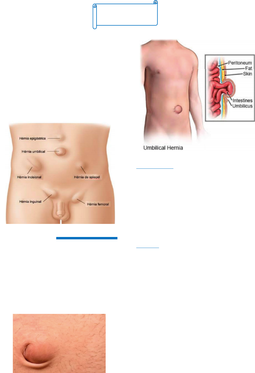 Hérnia inguinal nos praticantes de musculação - Hernia Clinic