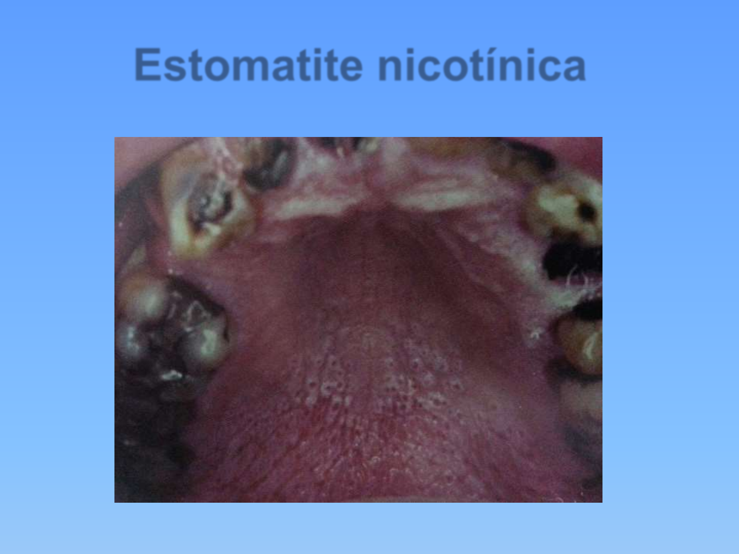 estomatitis nicotínica