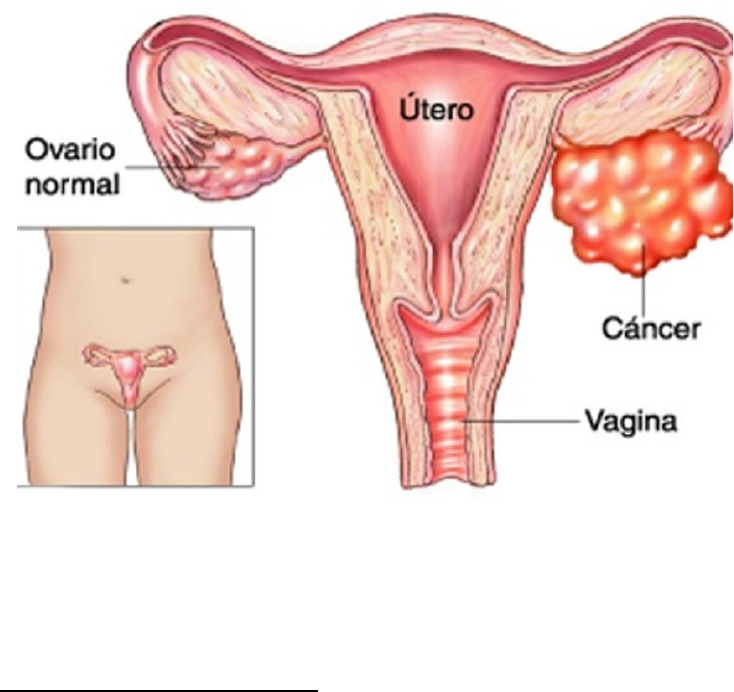 Ooforectomia - Cirurgia