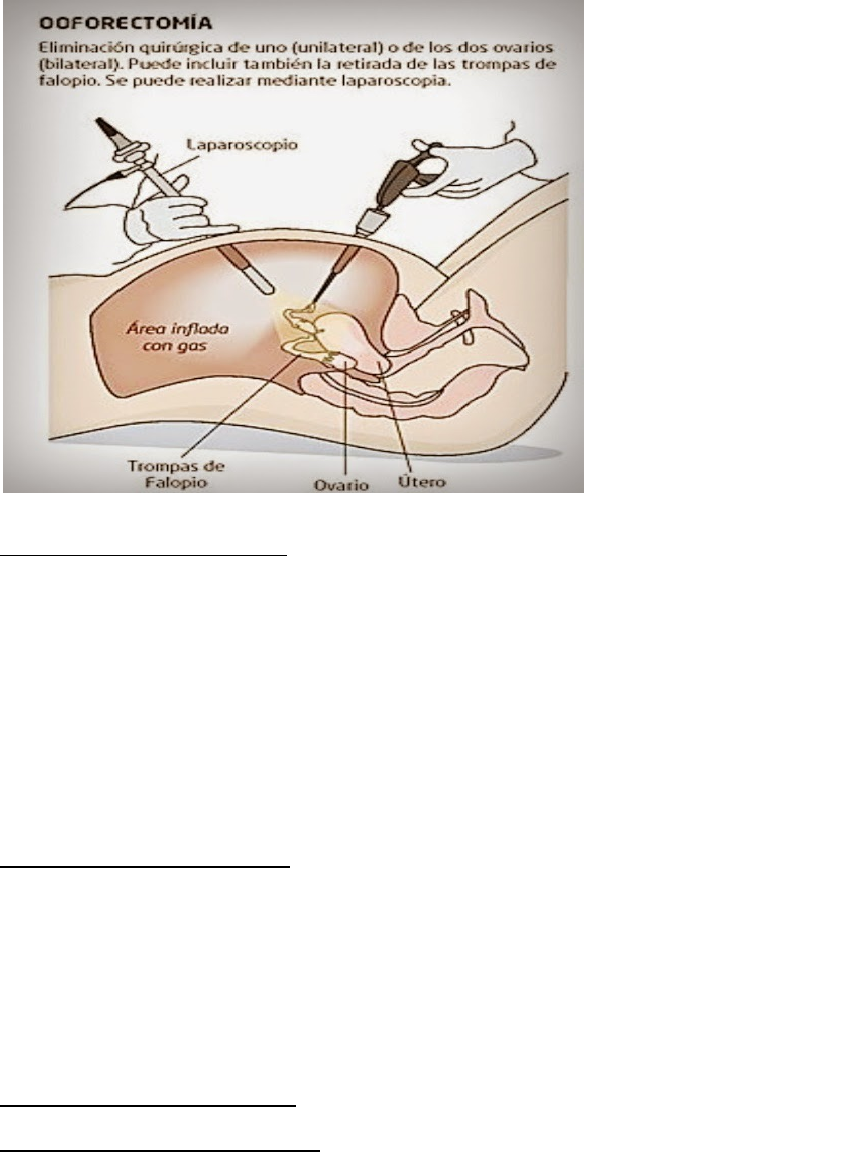 Ooforectomia x Ooforoplastia - Cirurgia no ovário 