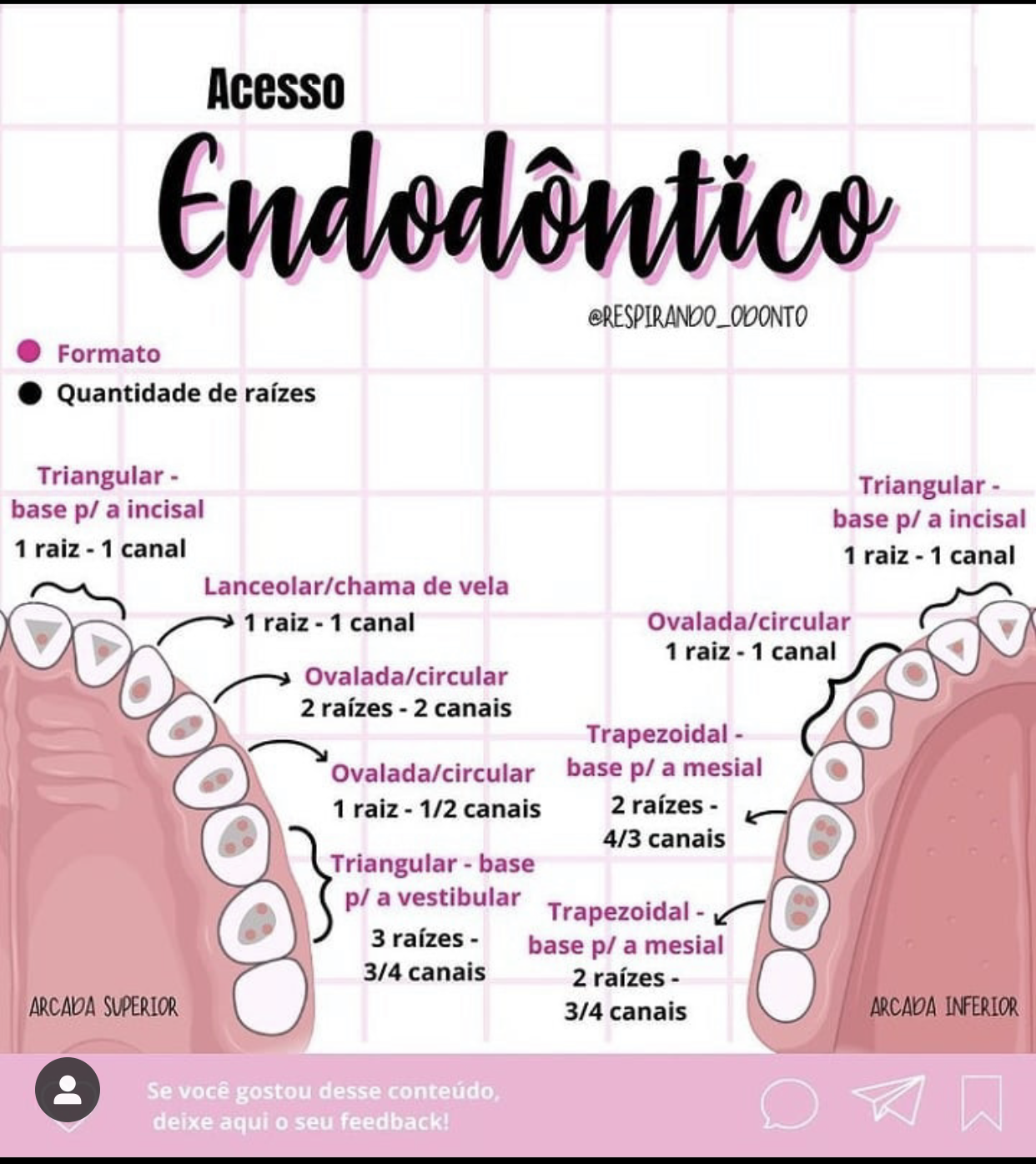 Ponto De Acesso Coron rio Endodontia ponto-de-acesso-coron-rio-endodontia