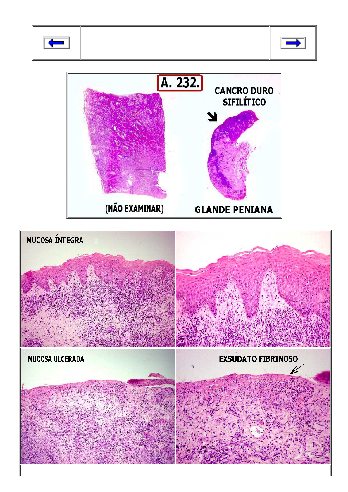 Cancro duro foto