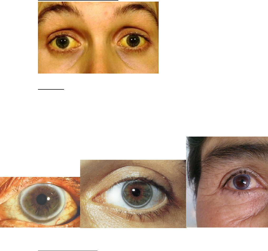 PPT - DOENÇA DE WILSON PowerPoint Presentation, free download - ID:237613, image size:1017x952