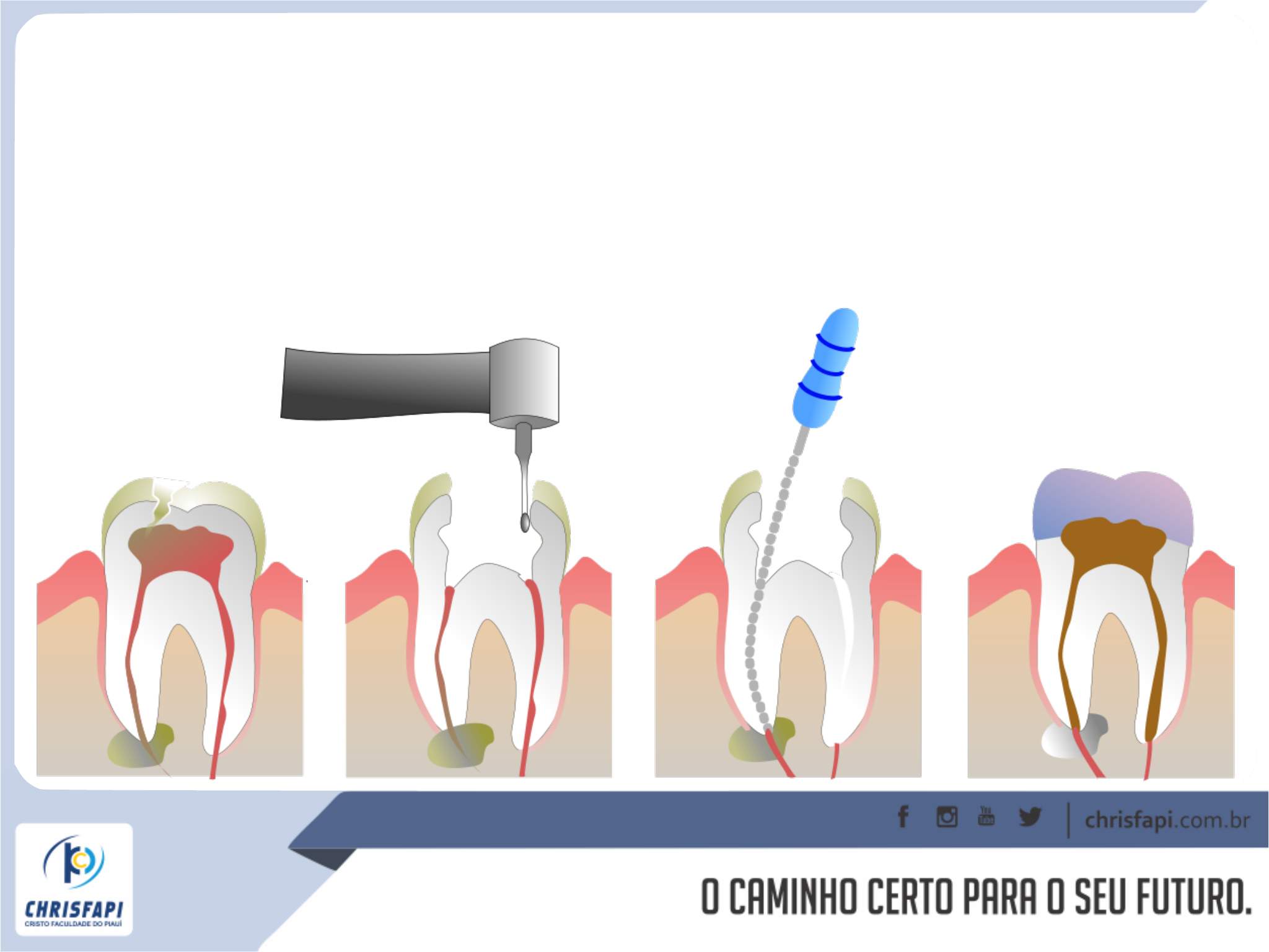 Endodontia - Odontologia