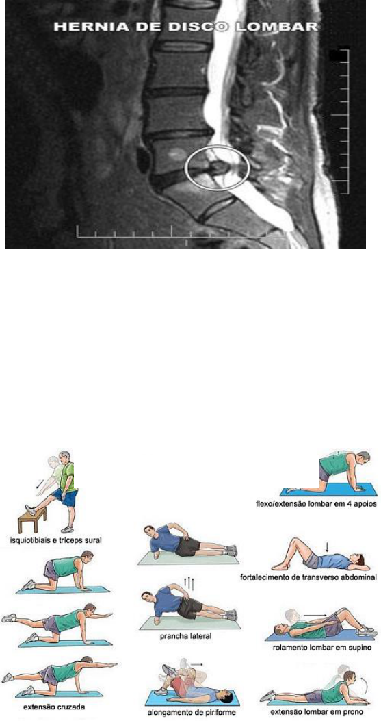 O exercício no tratamento da hérnia de disco lombar - Educação Física
