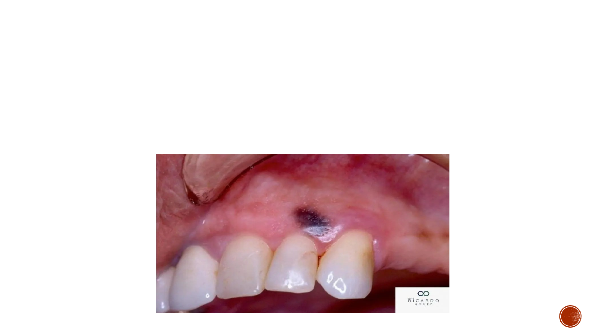 Grtis: MACULA MELANOTICA MULTIPLA- APRESENT - Material Claro e Objetivo em  PDF para Estudo Rpido
