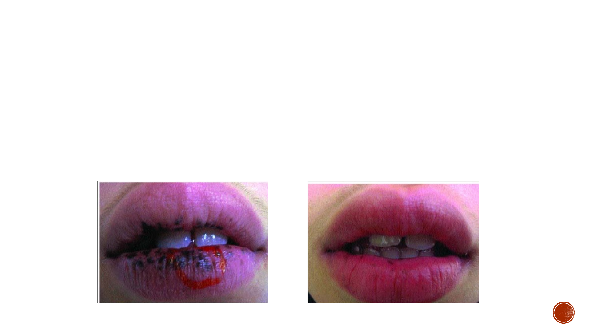how much do melanotan injections cost Lesiones Pigmentadas  Patologia Oral, General, Bioestadstica, Metodologa  de la Investigacin