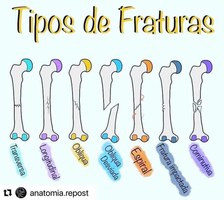 Tipos De Fraturas - Ortopedia