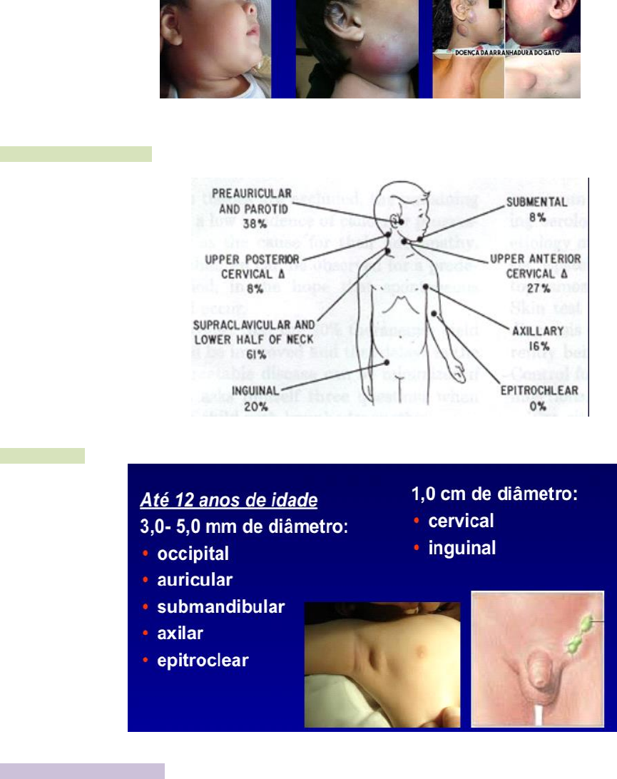 Inflamación Axilar derecha secundaria a Linfadenopatía Foto de stock  1918491044 | Shutterstock, image size:865x1092