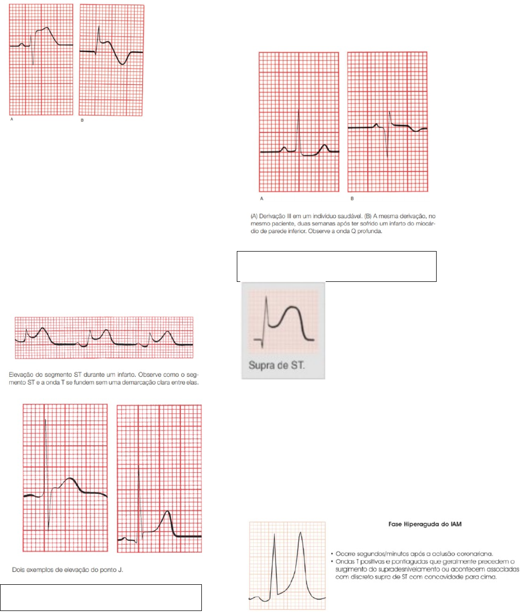 Grátis: 4. Infarto e isquemia no Eletrocardiograma - Material Claro e  Objetivo em PDF para Estudo Rápido, image size:1024x1192