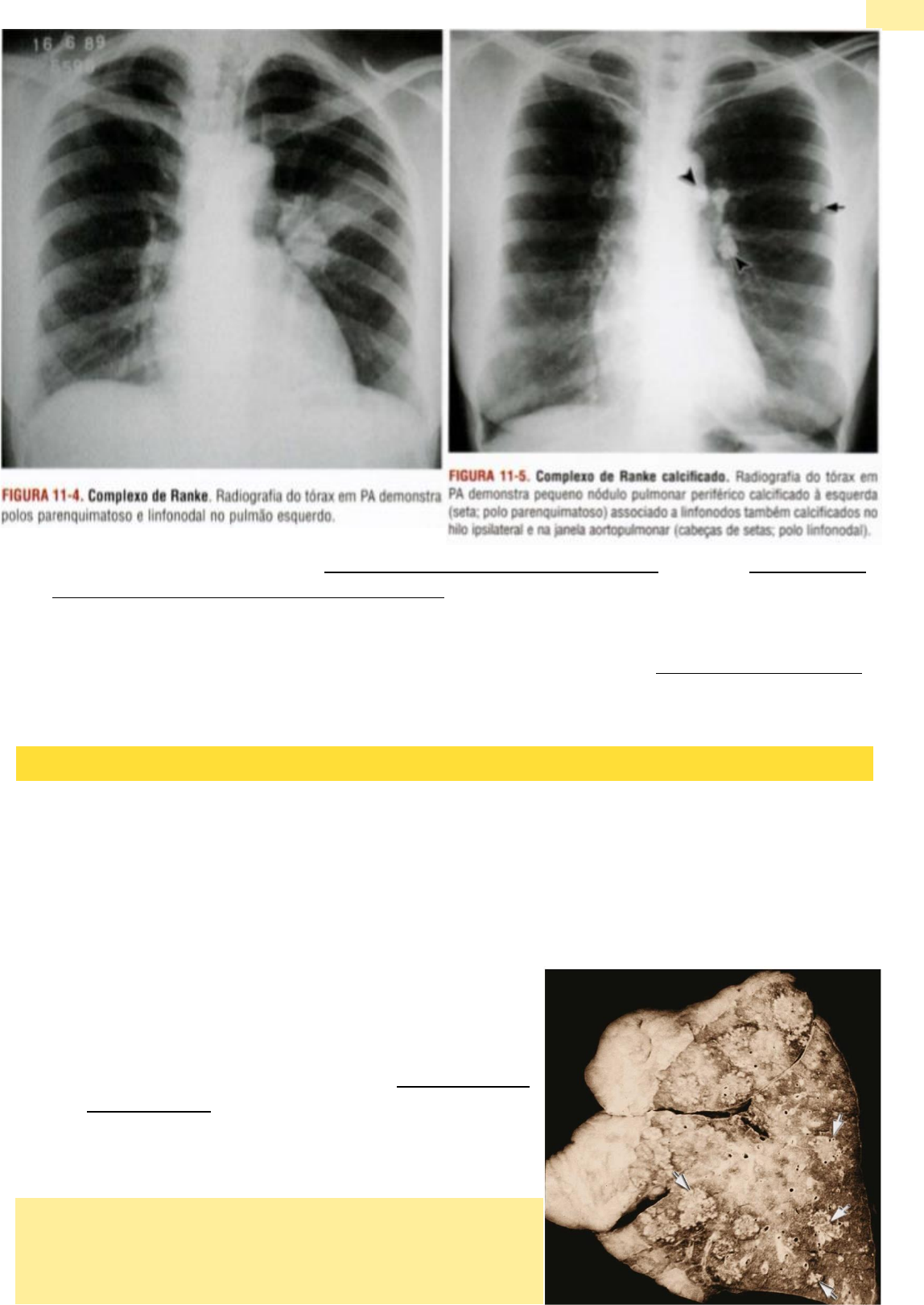 Grátis: Imagem da Tuberculose - Radiologia P5 - Material Claro e Objetivo  em PDF para Estudo Rápido, image size:1148x1621