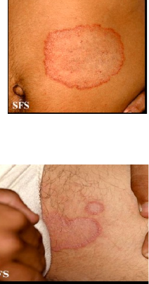 MICOSES SUPERFICIAIS - Dermatologia