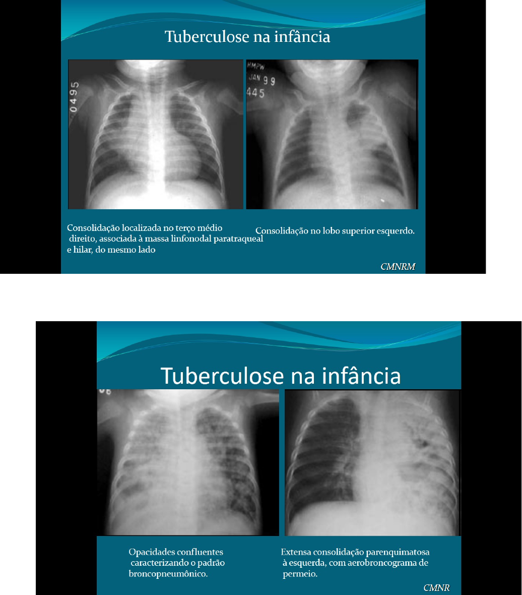 Grátis: Aula 07 - Tuberculose Pulmonar - Material Claro e Objetivo em PDF  para Estudo Rápido, image size:1036x1180