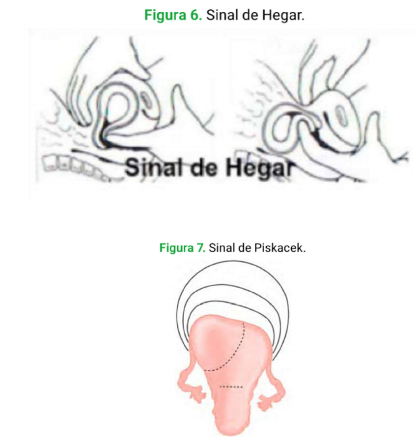 PROBABILIDADE DE GESTAÇÃO: SINAL DE PISKACEK