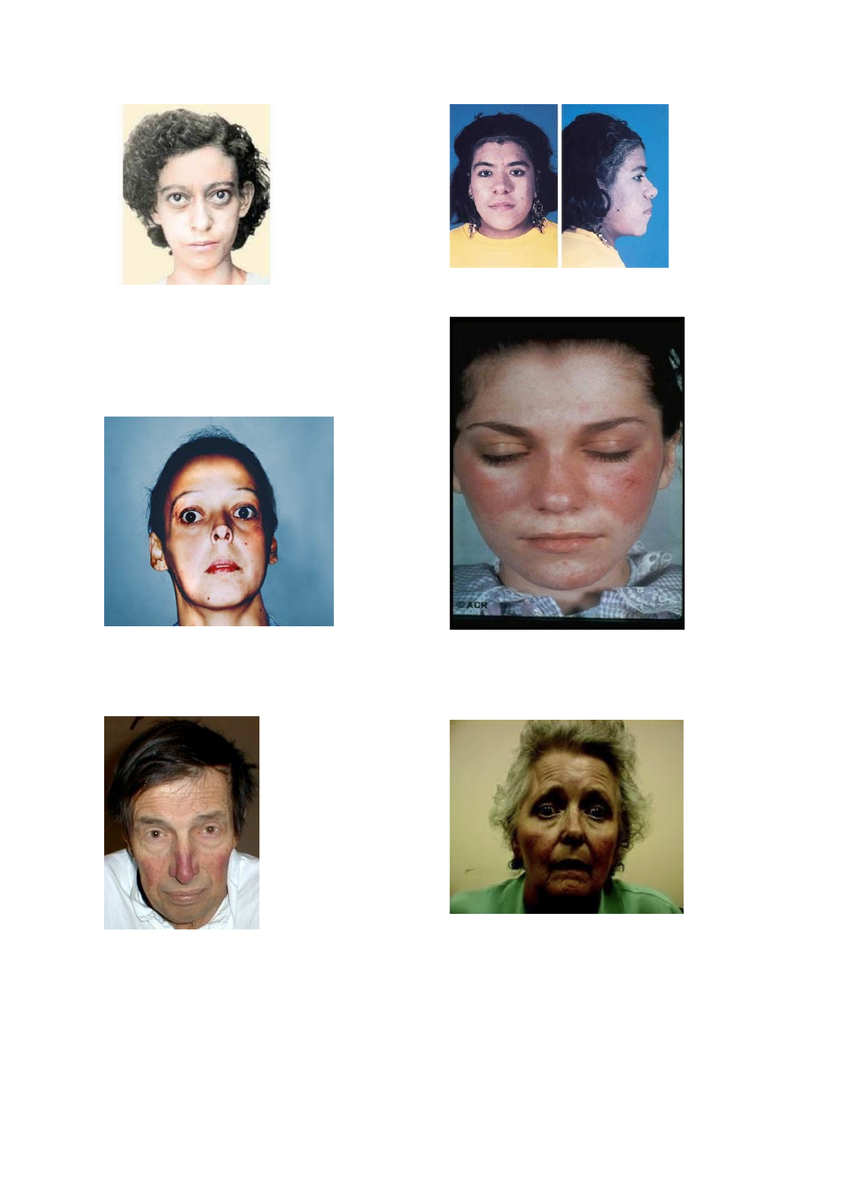 Basal cell nevus syndrome: From DNA to therapeutics - Clinics in Dermatology, image size:1191x1684