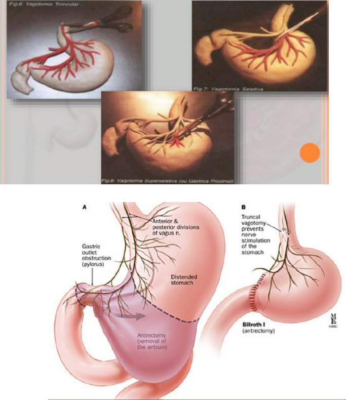 vagotomía y piloroplastia