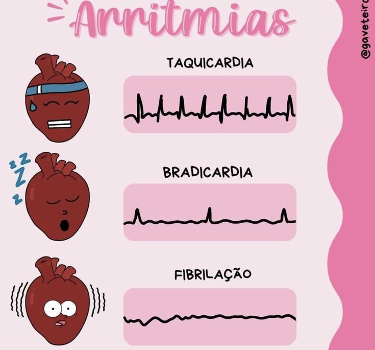 Tipo De Arritmia - Biologia