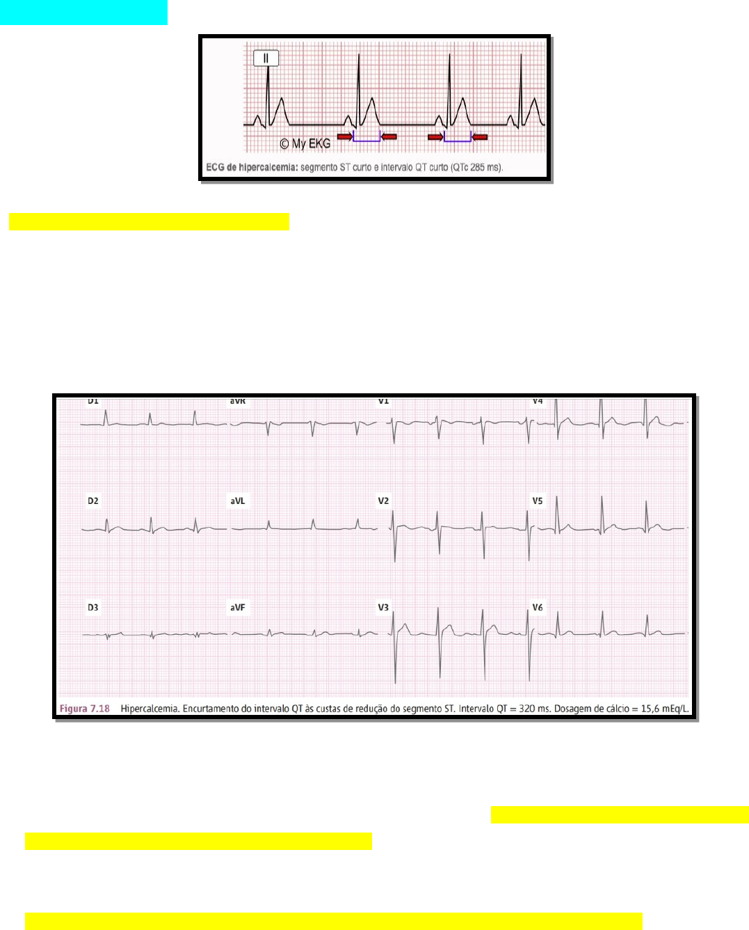 electrocardiograma de hipercalcemia