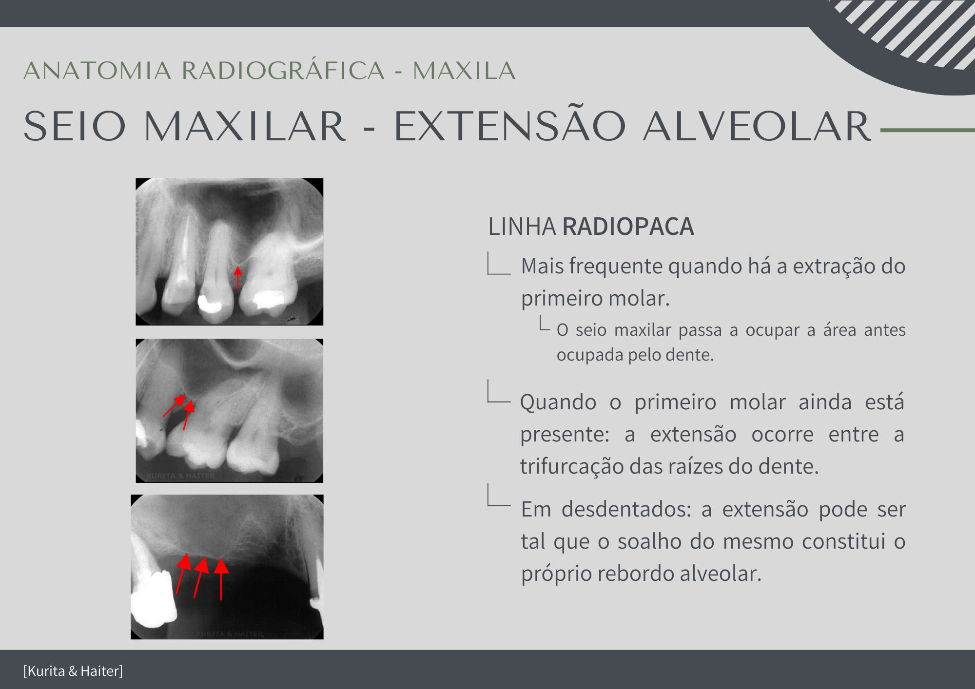 Anatomaia Radiográfica Extensão Alveolar Do Seio Maxilar Radiologia Odontológica 