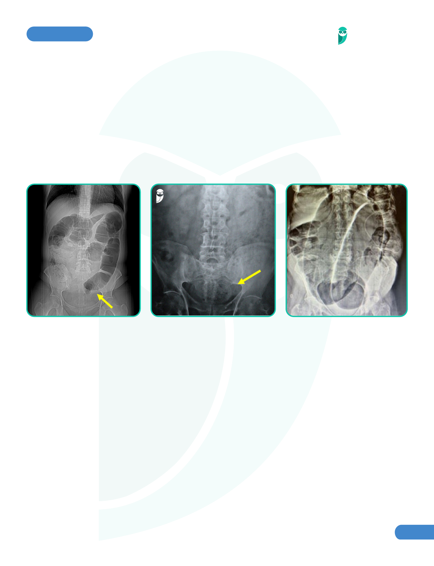 Intestino Preso na Criança | PediatriaVirtual.com, image size:1389x1814