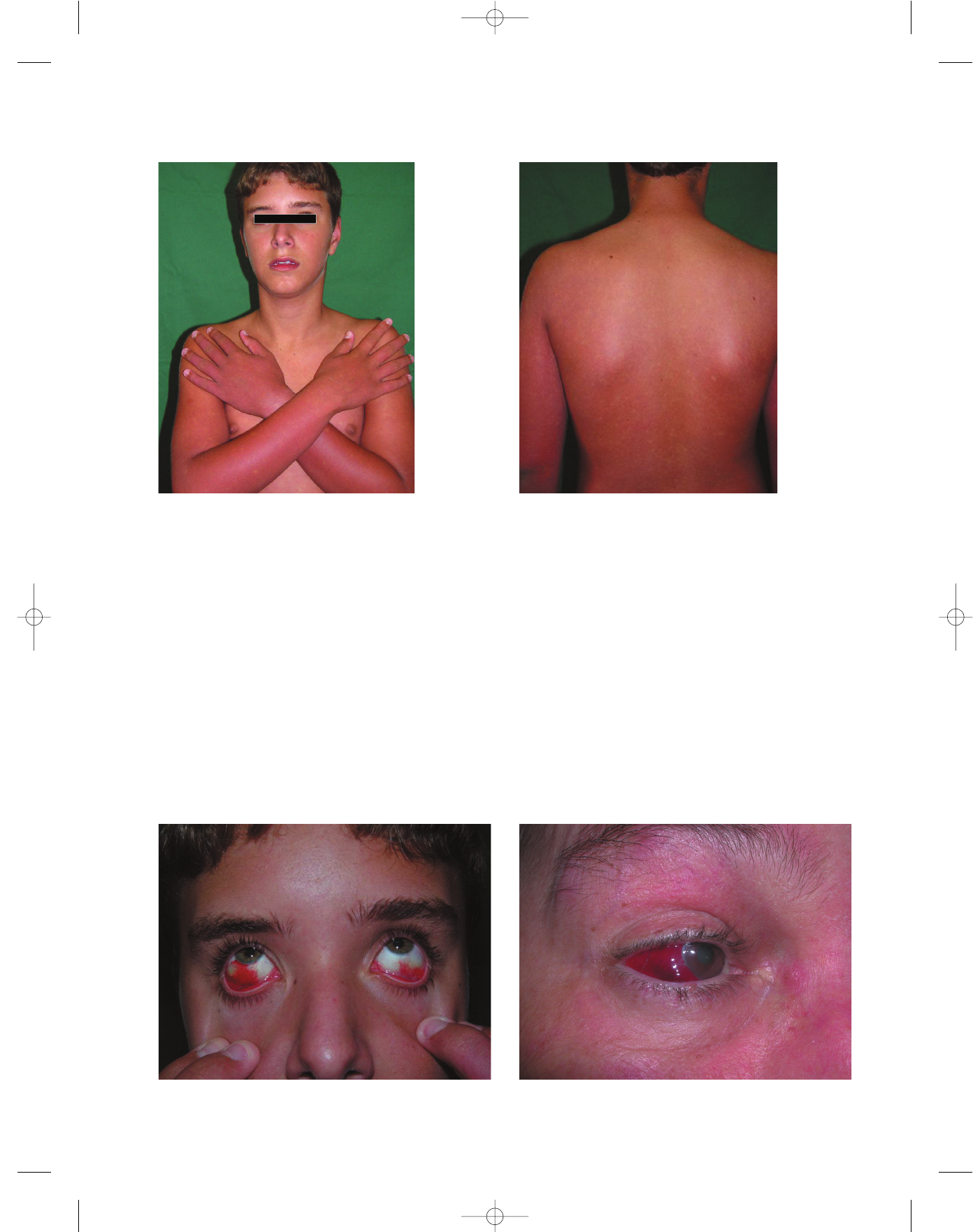 Grátis: Manifestações mucocutâneas da dengue - Material Claro e Objetivo em  PDF para Estudo Rápido, image size:1392x1763