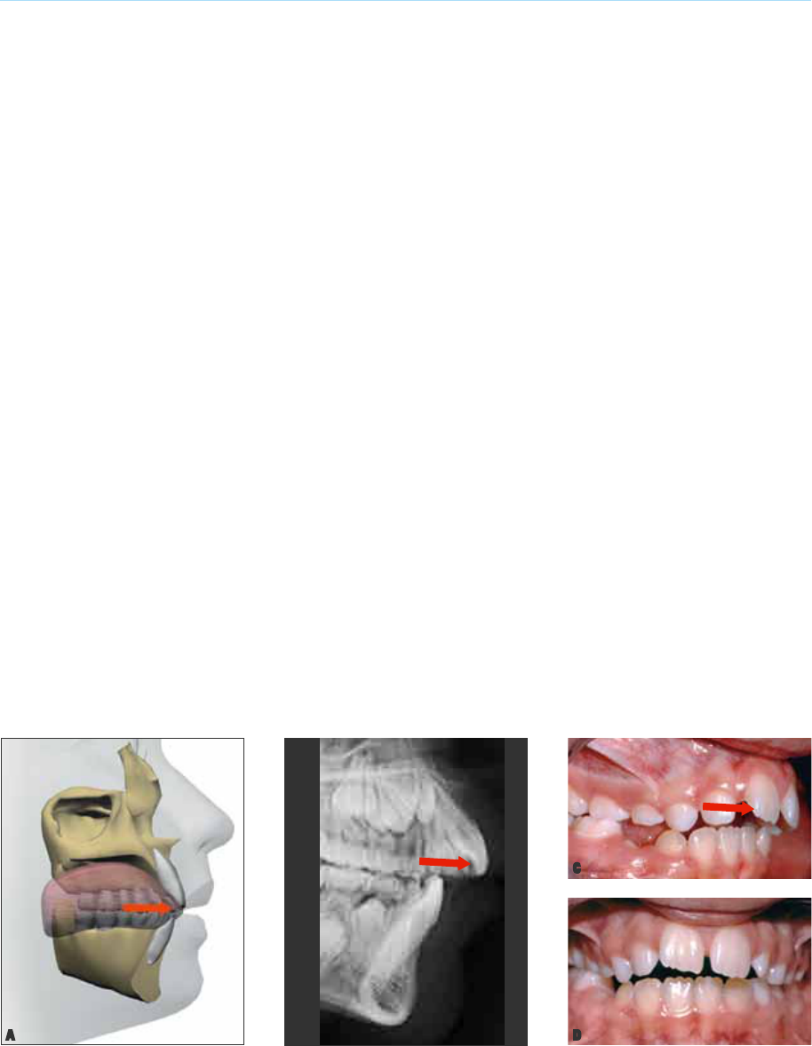 Exercícios Cirurgia Mewing Resultado Uma Remodelação Maxilar fotos