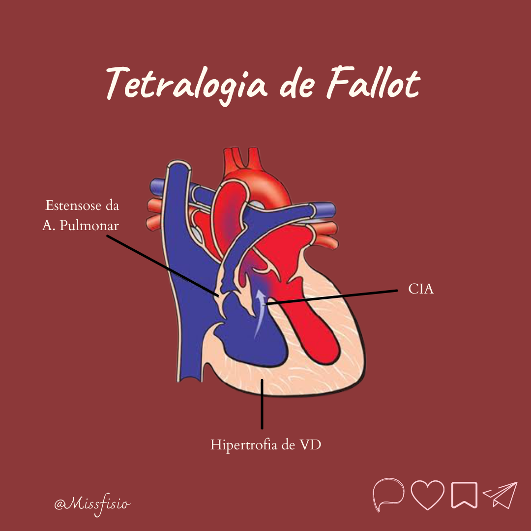 O Que é Tetralogia De Fallot - SAVAEDU